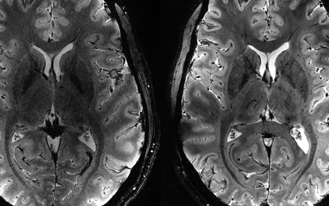 Quand le nez devance le cerveau : l’olfaction, sentinelle des maladies neurodégénératives.